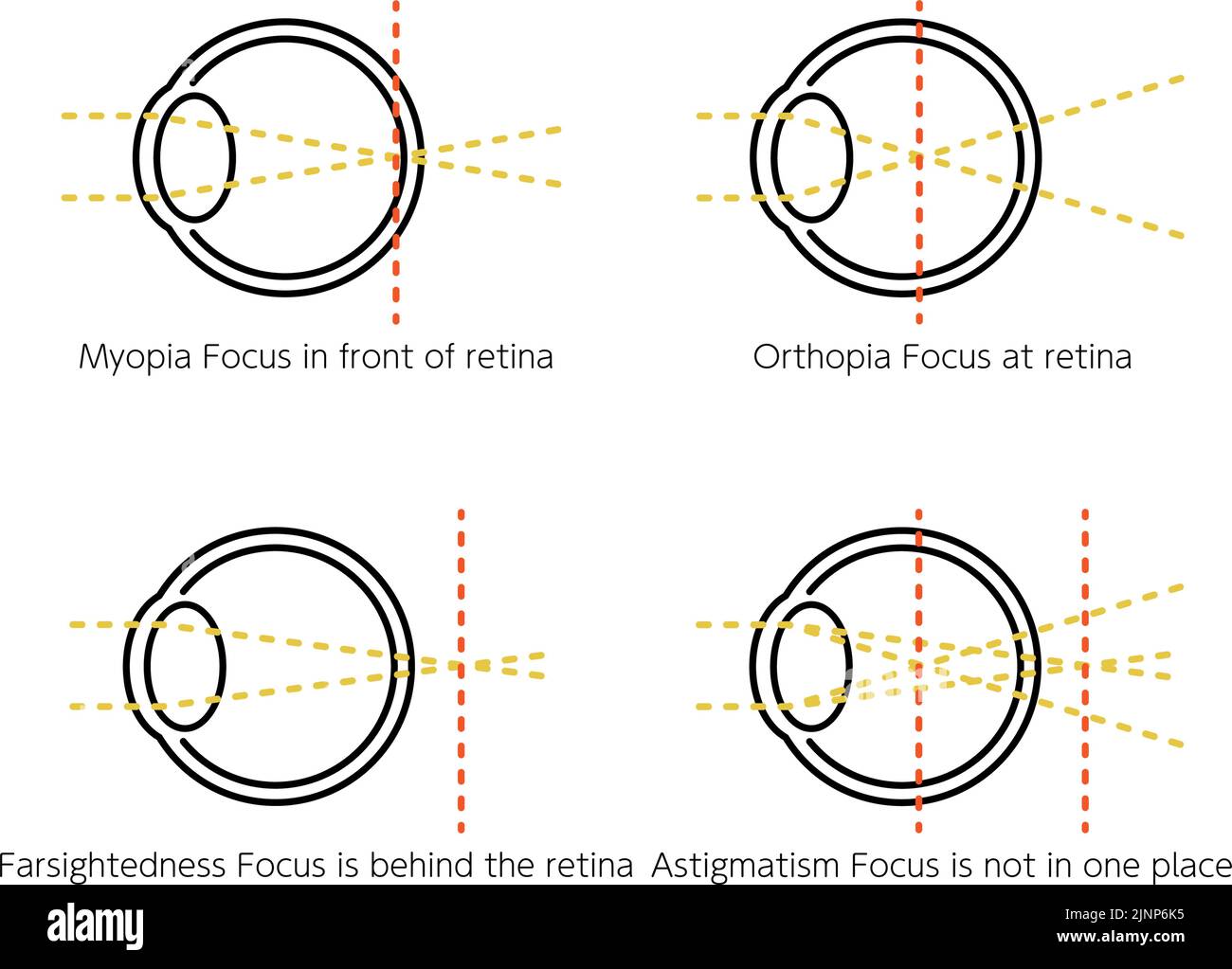 Medical Illustrations of Vision and Refractive Error, Normal, Myopia, Hyperopia, Astigmatism Stock Vector