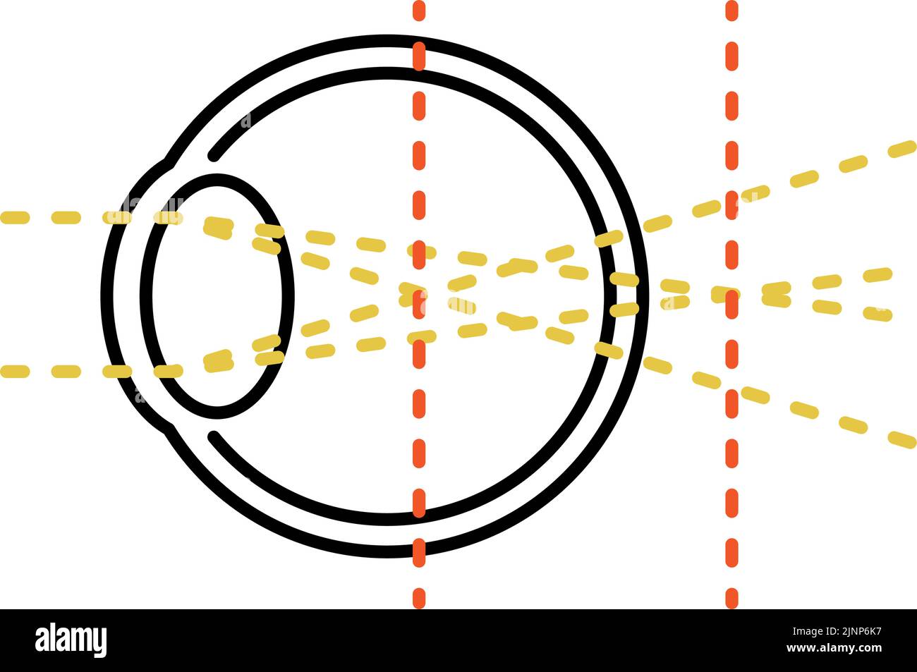 Medical Illustration of Visual Acuity and Refractive Error, Astigmatism