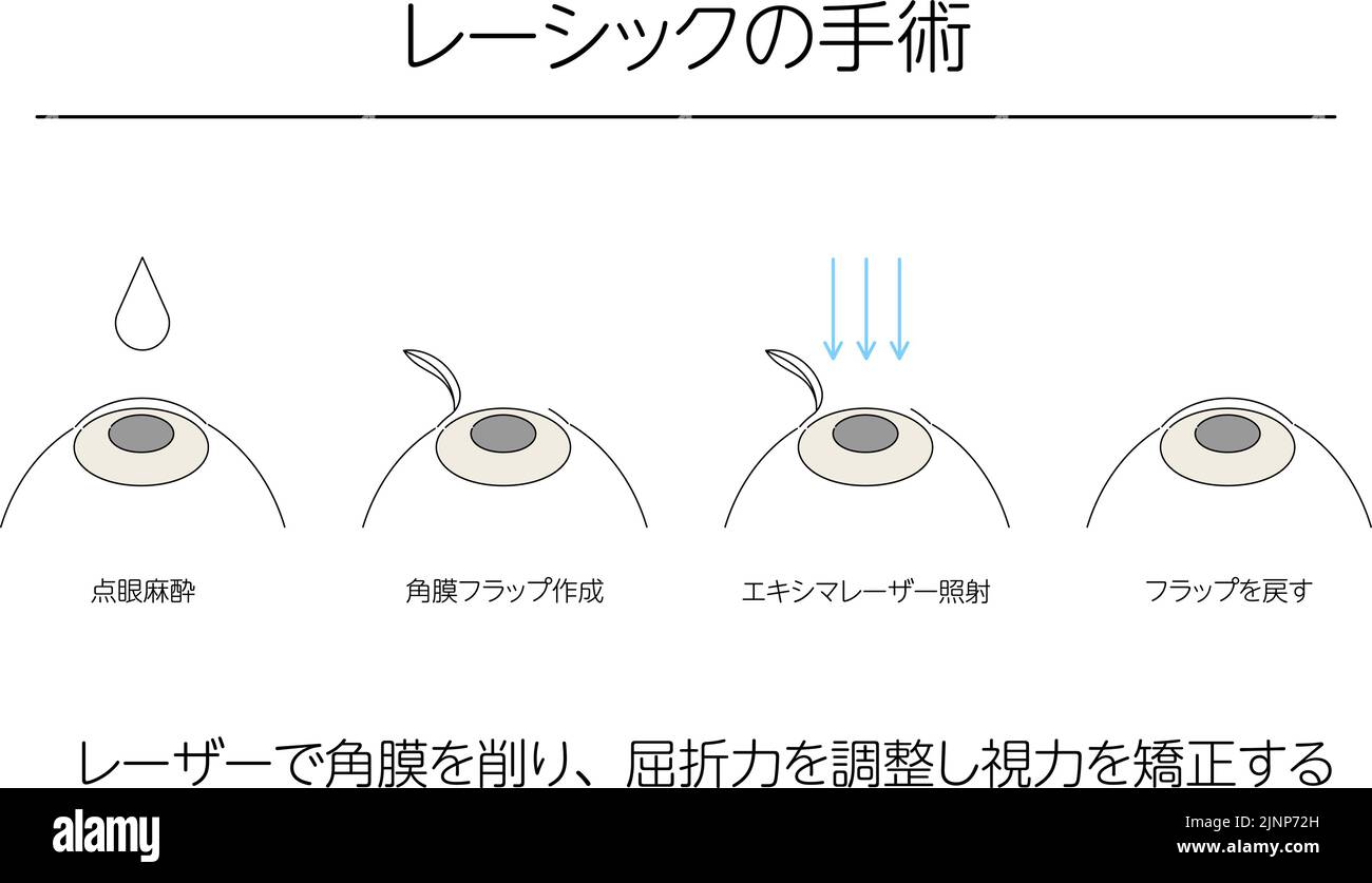 Illustration, LASIK vision correction, medical illustration. - Translation: LASIK surgery, laser shaving of the cornea to adjust refractive power and Stock Vector