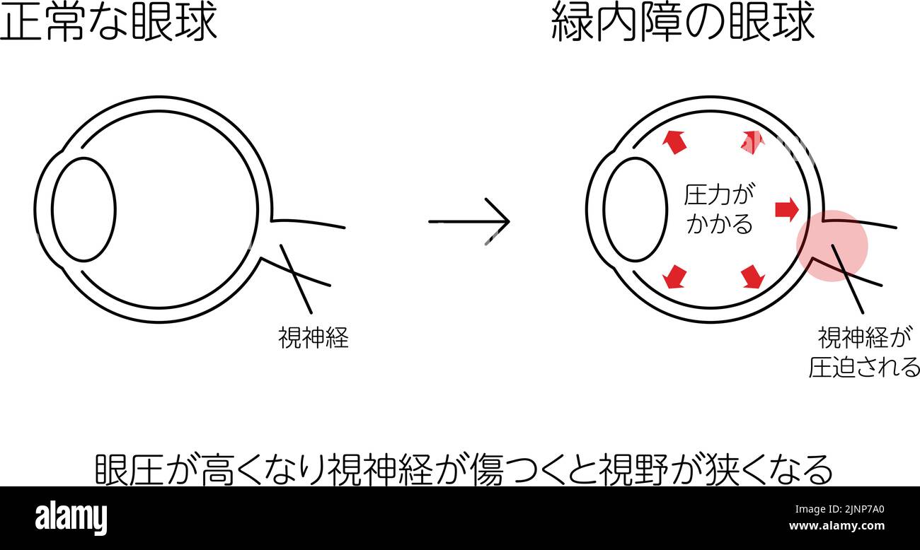 Illustration of how works, normal and eyes