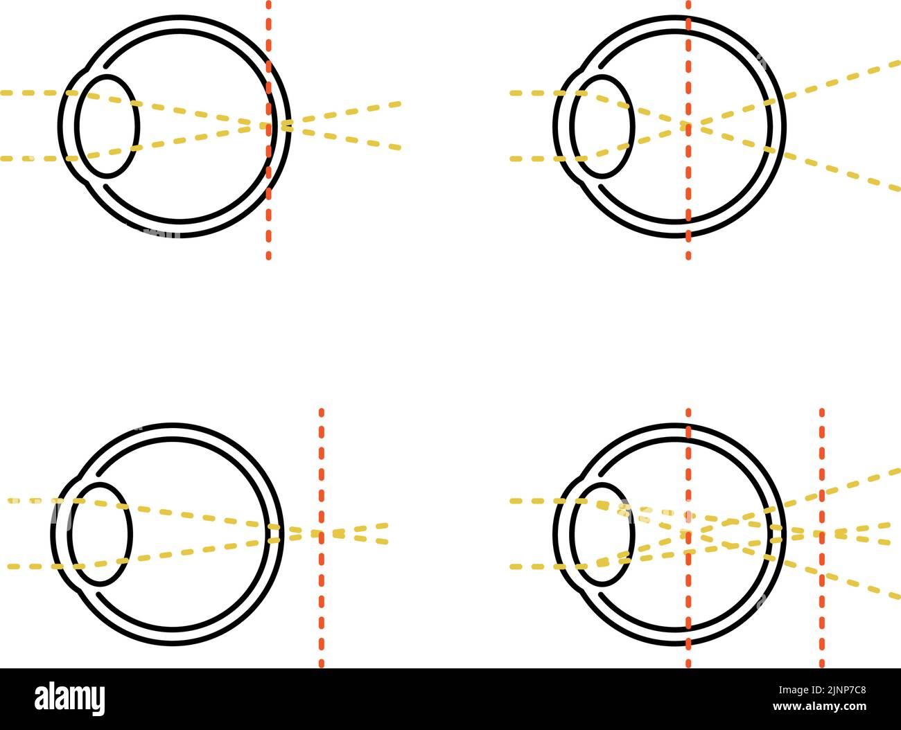 Medical Illustrations of Vision and Refractive Error, Normal, Myopia, Hyperopia, Astigmatism Stock Vector