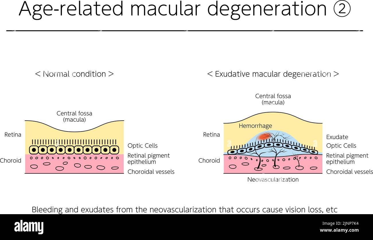 Eye Disease, Exudative Age-Related Macular Degeneration Illustrated Stock Vector