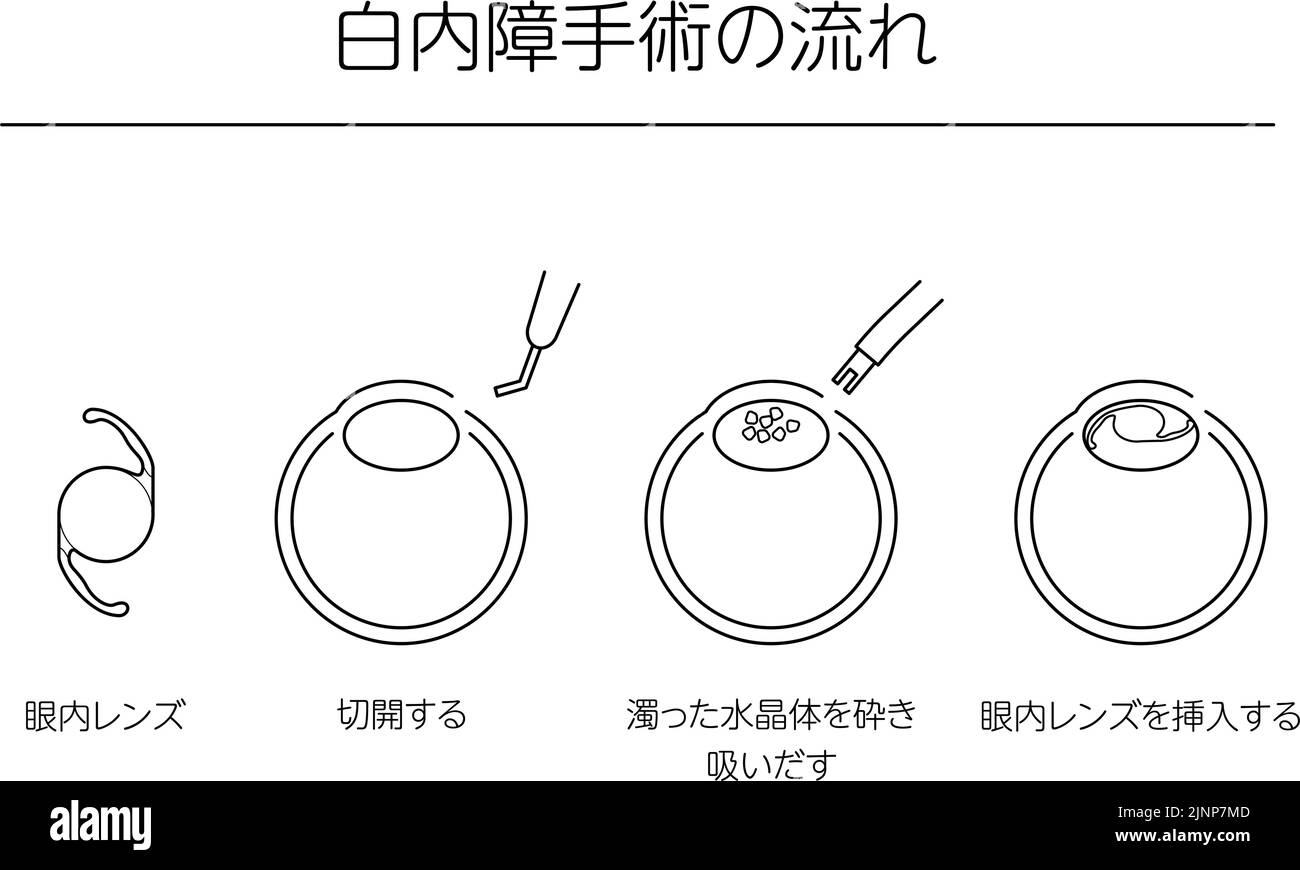 Flow of cataract surgery, illustrated illustration (line drawing) - Translation: flow of cataract surgery, intraocular lens, making incision, sucking Stock Vector