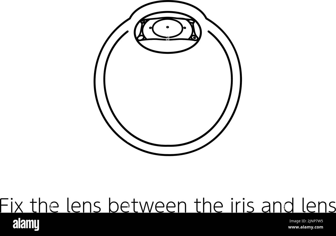 Illustration of ICL (intraocular contact lens) surgery and ICL fixation ...