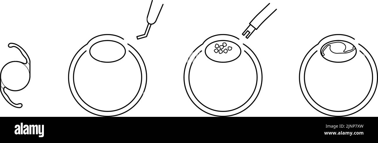 Flow of cataract surgery, illustrated illustration (line drawing) Stock Vector