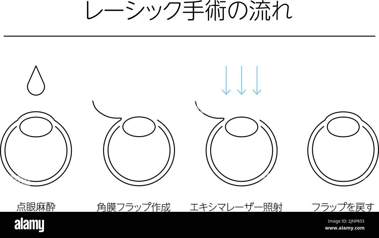 Medical illustration of LASIK and refractive surgery - Translation: LASIK surgery flow, eye drop anesthesia, corneal flap creation, excimer laser irra Stock Vector