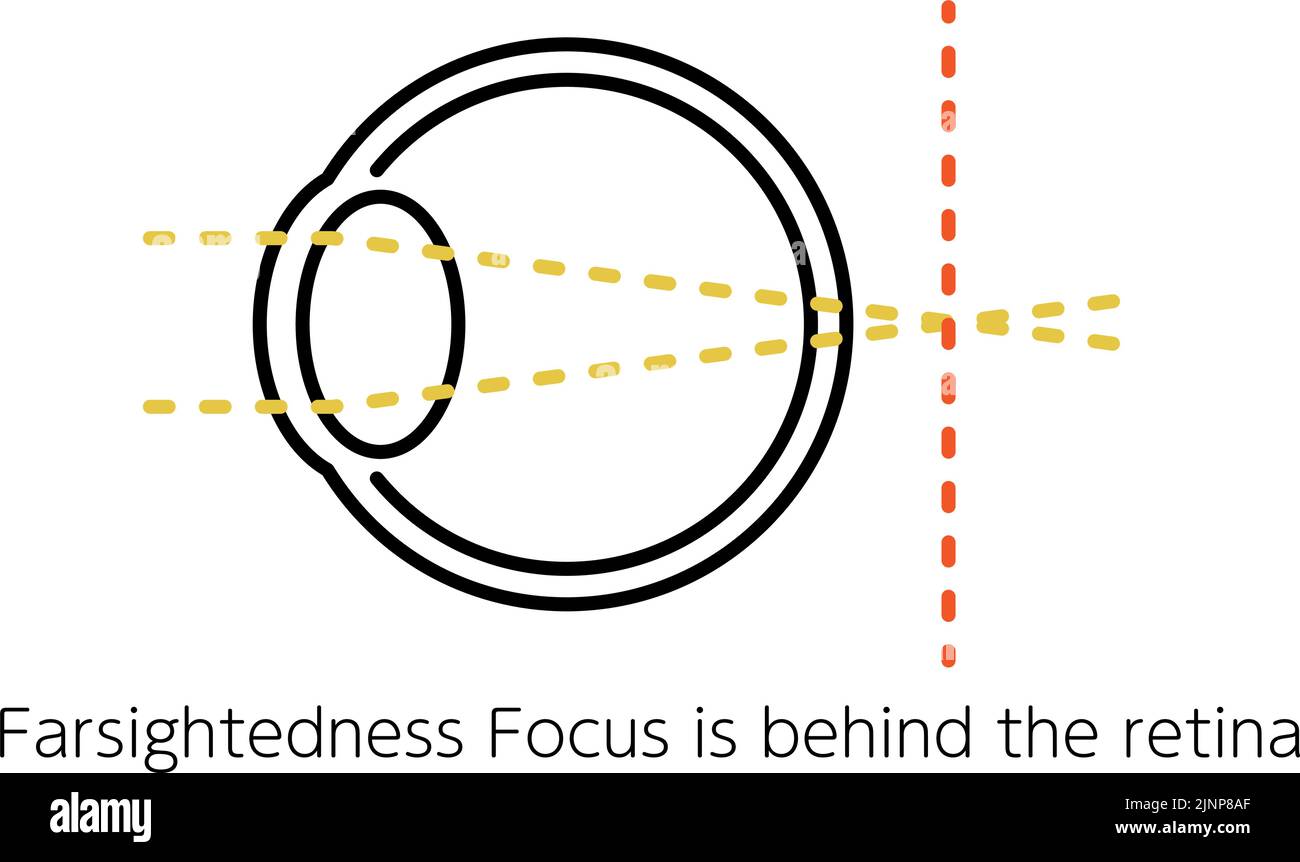 Medical Illustration of Visual Acuity and Refractive Error, Hyperopia