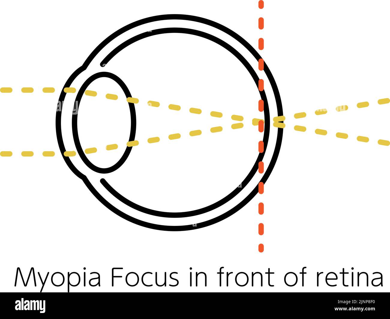 Medical Illustration of Visual Acuity and Refractive Error, Orthopia