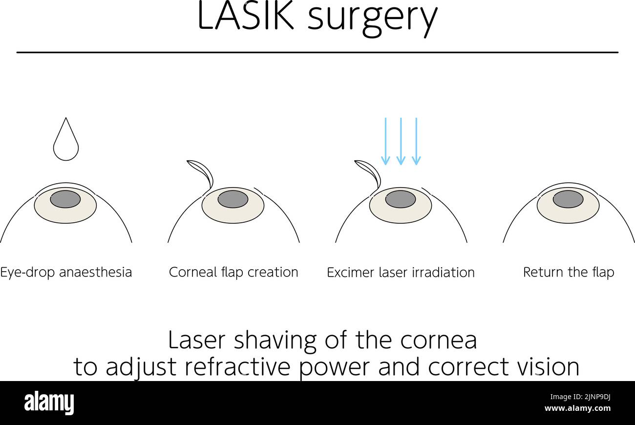 Illustration, LASIK vision correction, medical illustration. Stock Vector