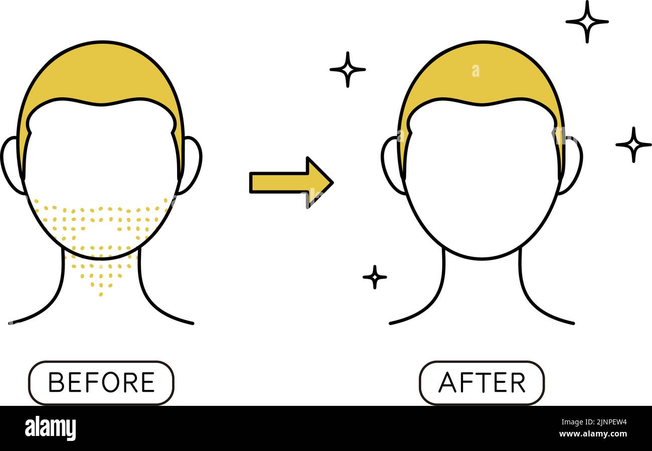 Image before and after beard hair removal treatment, from stubble to smooth skin Stock Vector