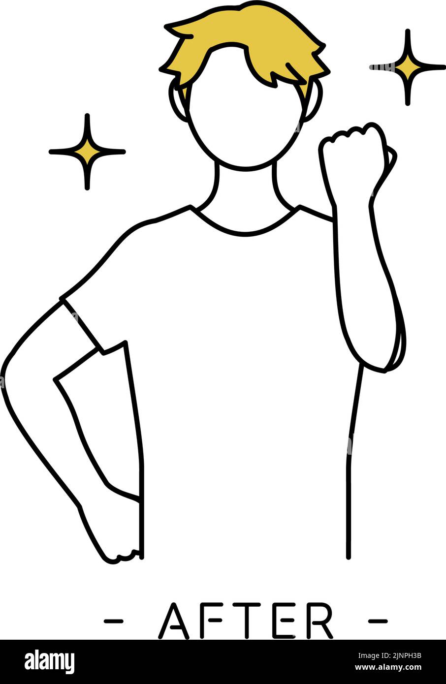 AGA Male pattern baldness male, thinning hair improved after AGA