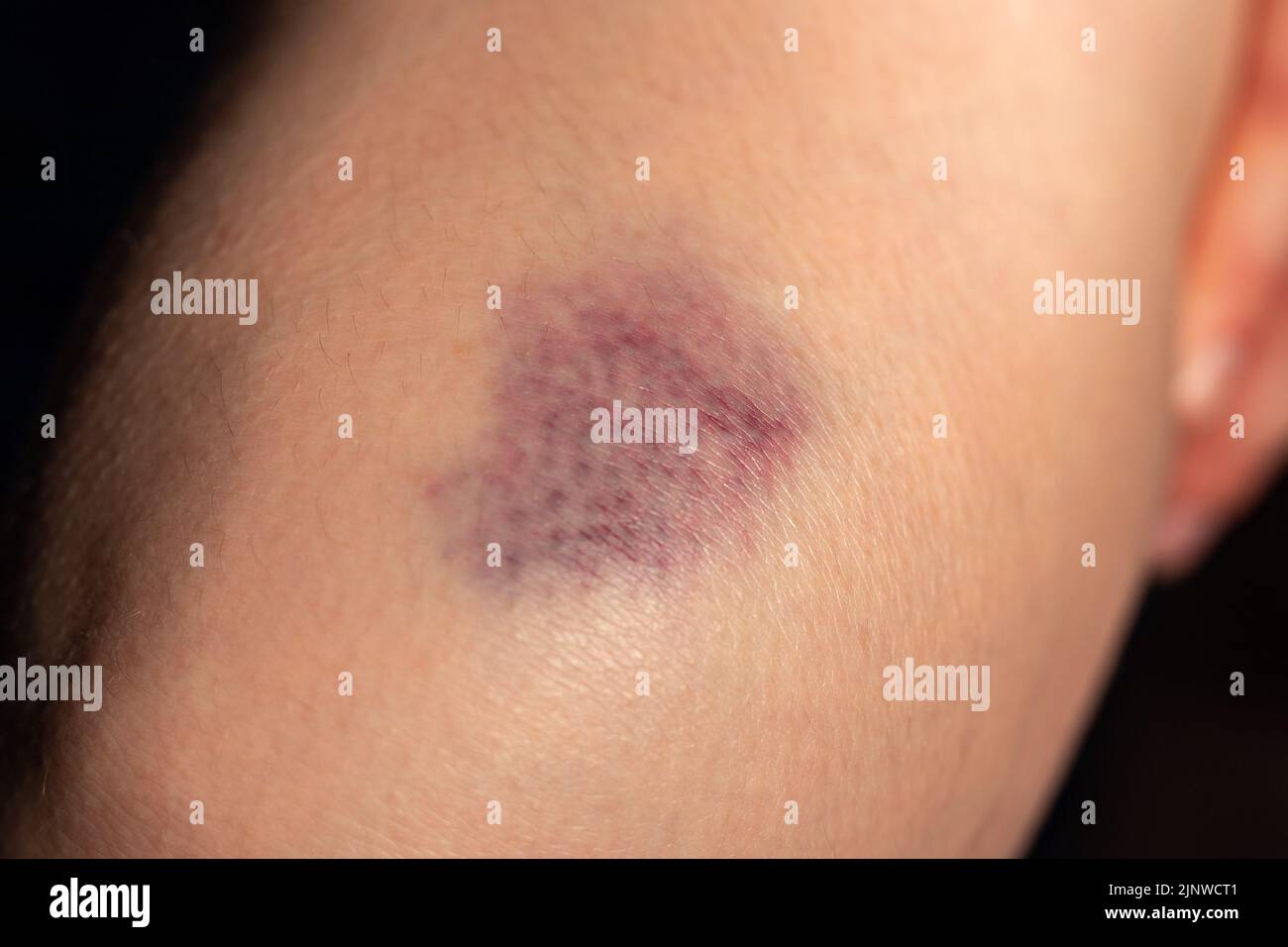 Photo of the bruise on woman leg Stock Photo