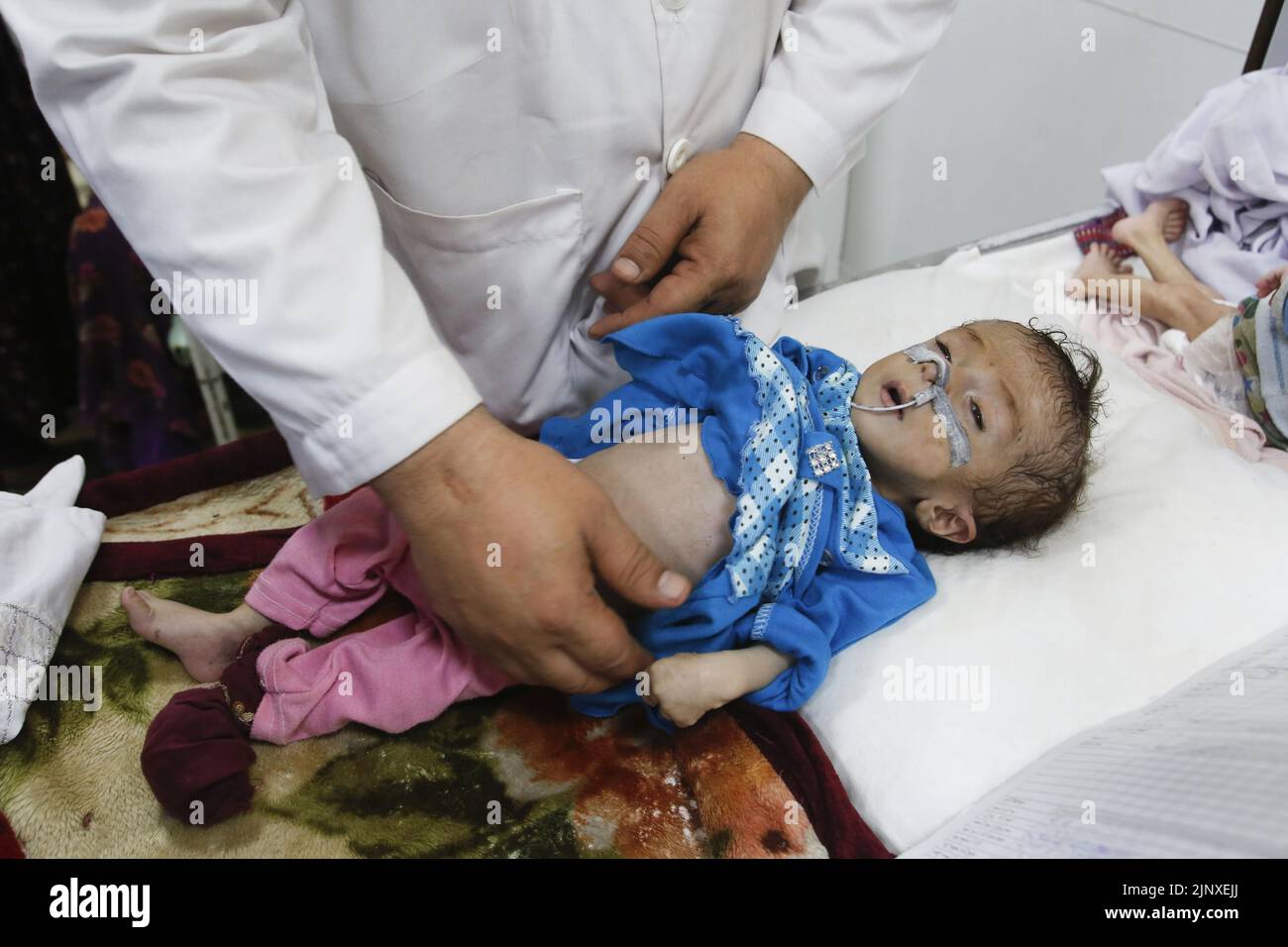 File photo taken in June 2022 shows a child receiving medical treatment for malnutrition at a hospital in Kabul. (Kyodo)==Kyodo  Photo via Newscom Stock Photo