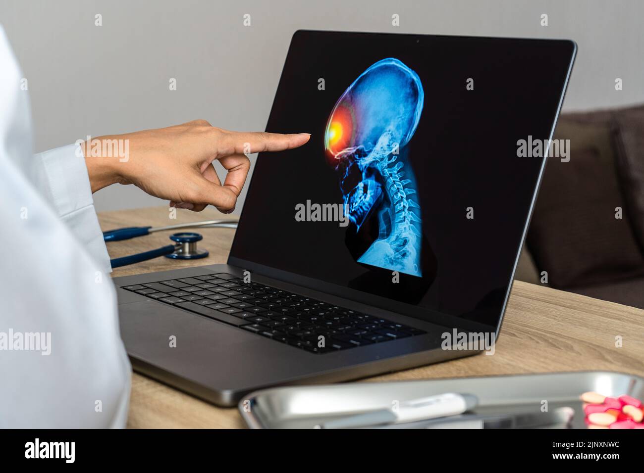 Close up of doctor looking a xray of pain in the brain on a laptop