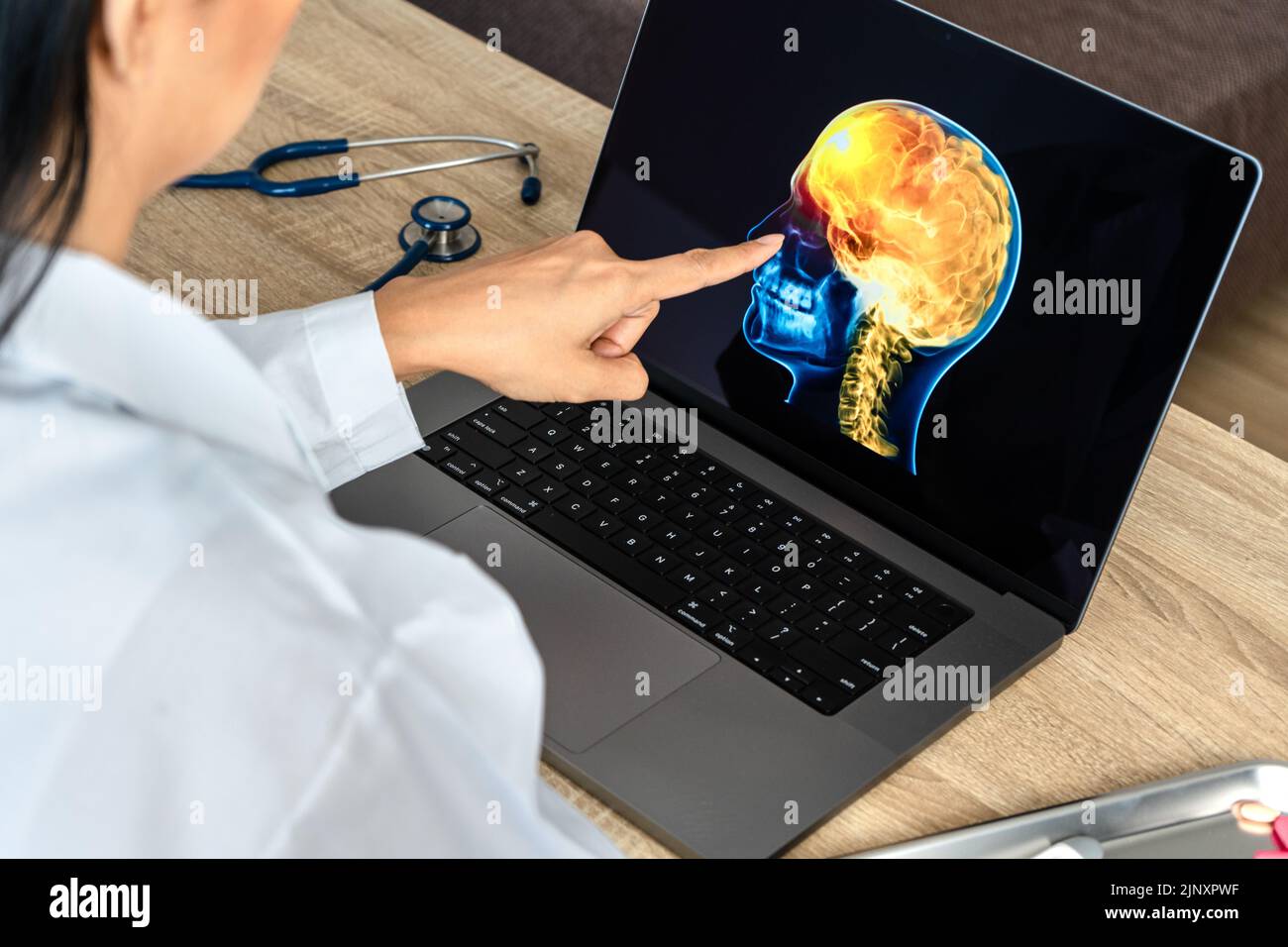 Doctor showing a x-ray of pain in the brain on a laptop. Migraine Headache Stock Photo