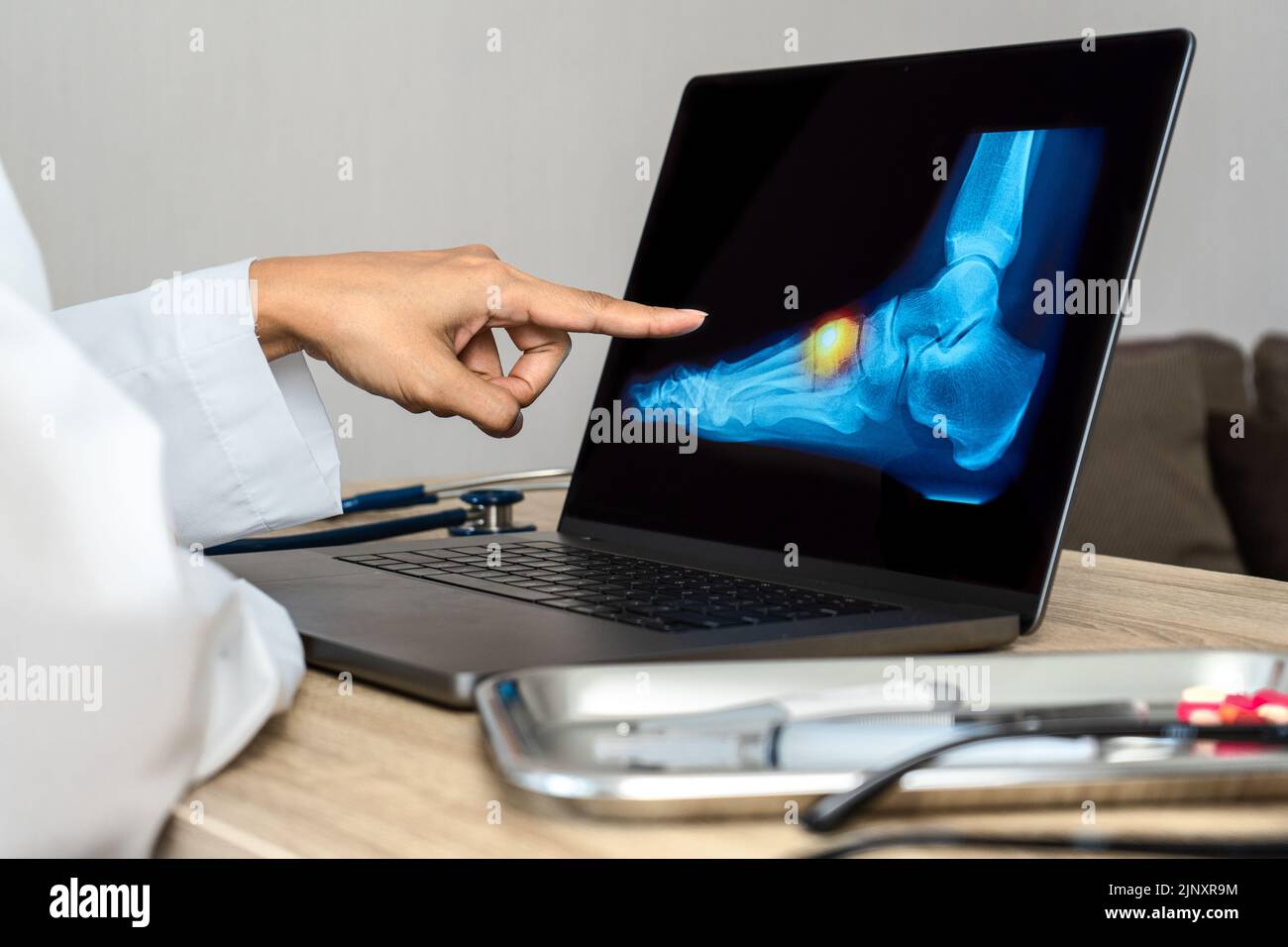 Close up of doctor showing a x-ray of foot. Pain foot injury Stock Photo