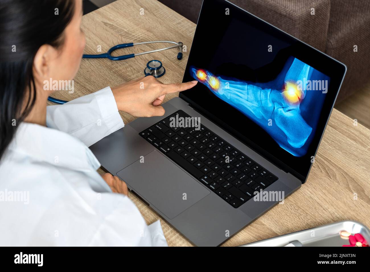 Close up of doctor showing a xray of foot. Pain ankle and toes injury