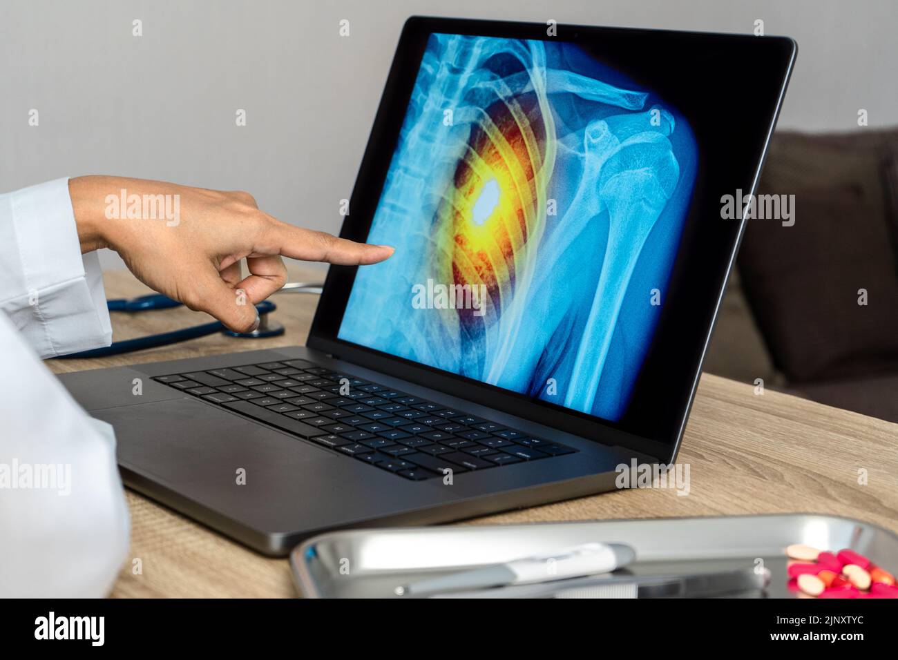 Doctor showing a x-ray of pain in the ribs. Heart attack or chest injury Stock Photo