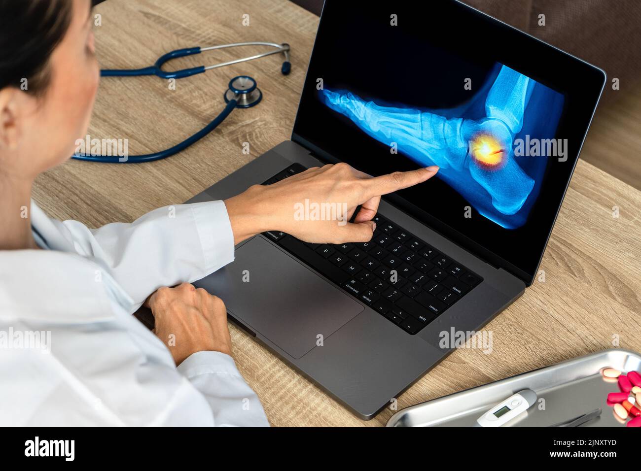 Close up of doctor showing a xray of foot. Pain ankle and foot injury