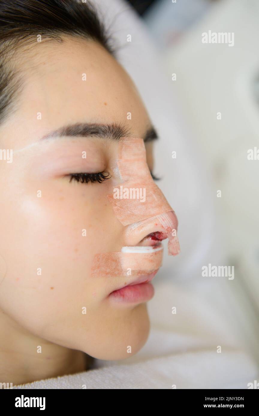 Side view of woman with bandage on her nose after rhinoplasty Stock Photo