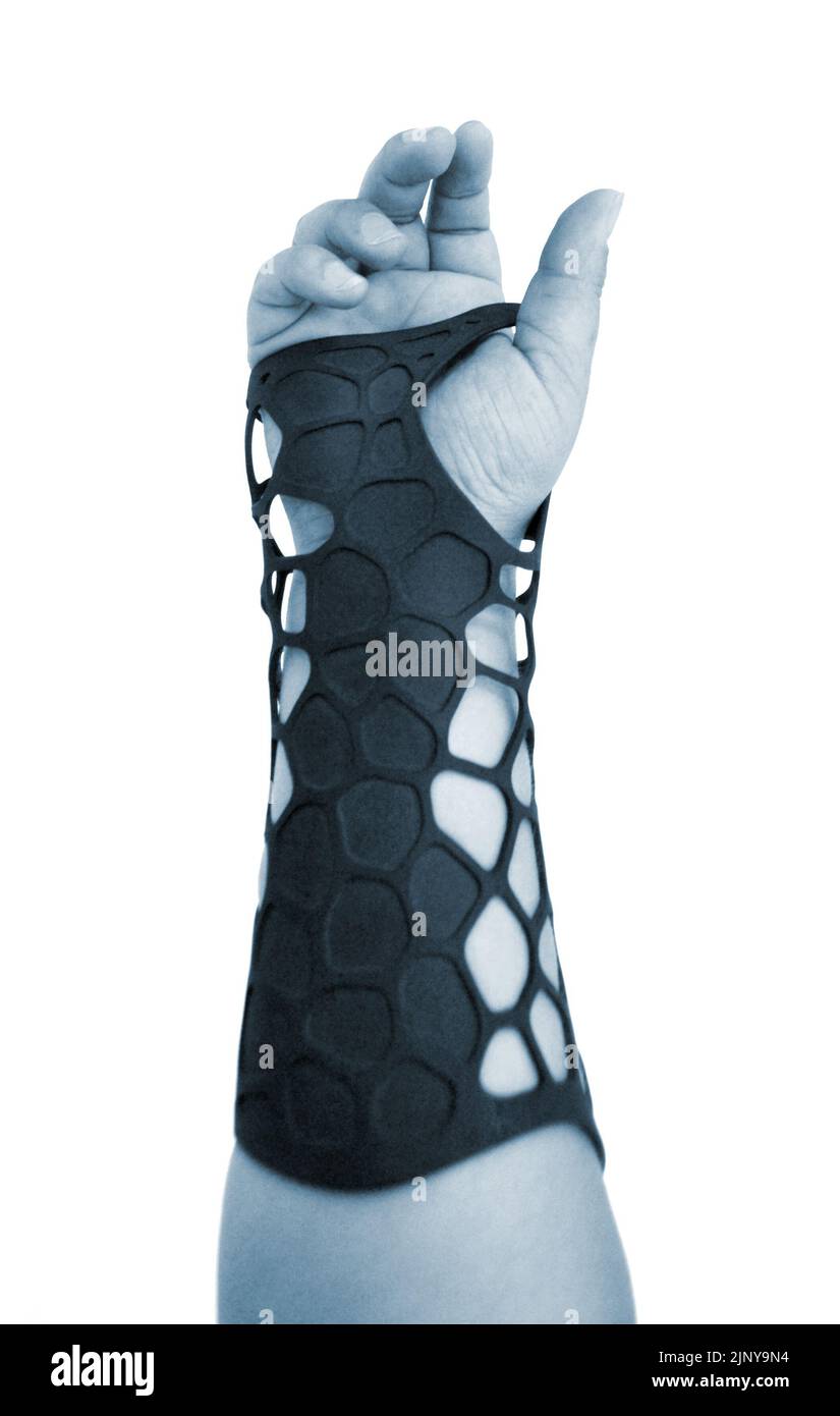 Orthopedic plastic prosthesis printed on powder 3D printer on hand