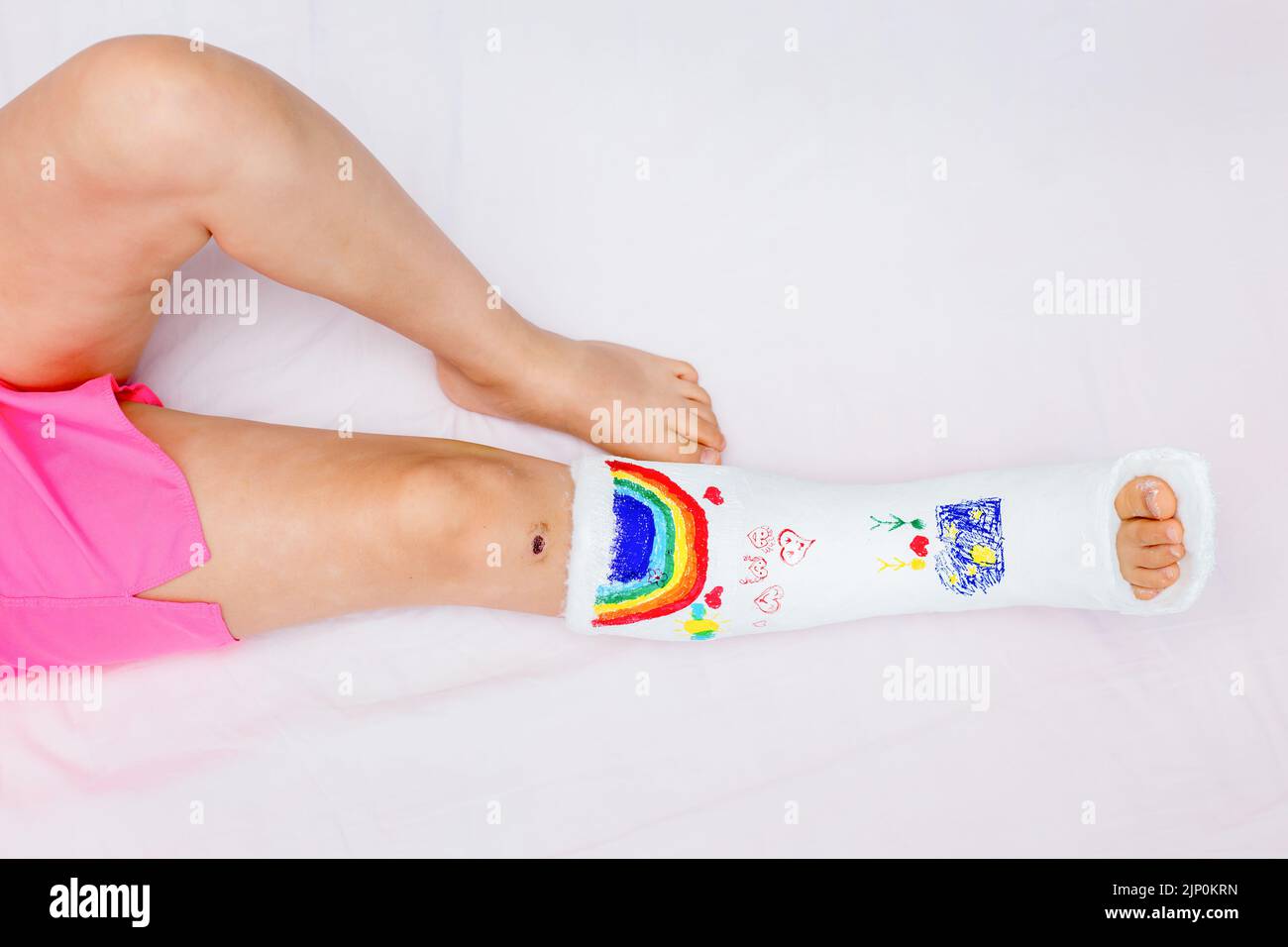 An unrecognizable little girl with a broken leg at home on the bed drew with felt-tip pens on an orthopedic cast. How to have fun with a broken leg Stock Photo