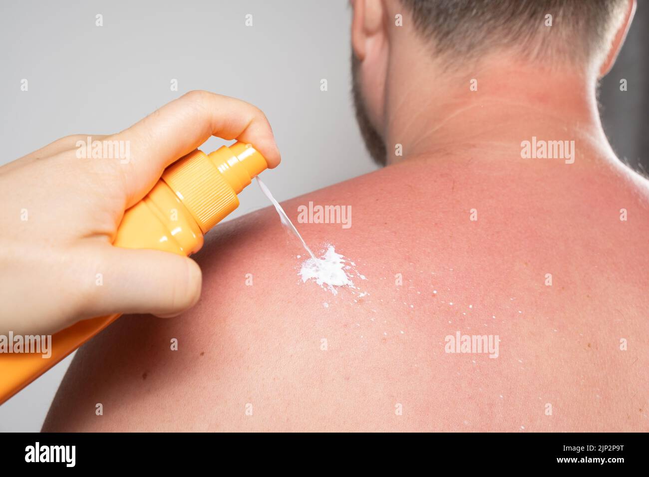 Applying sunscreen or therapeutic spray to the skin of a man with a