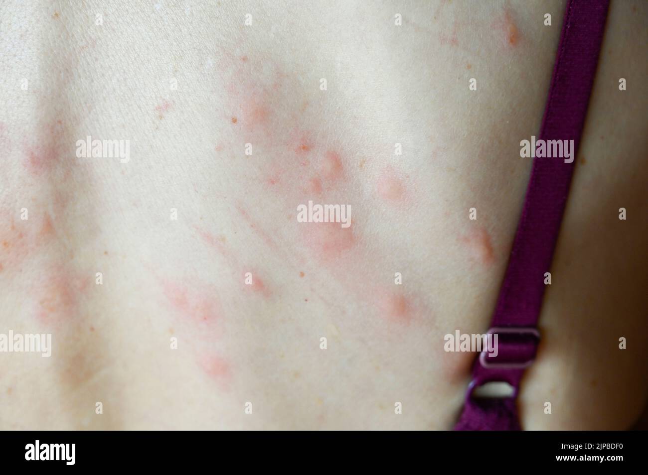 Allergic reaction to mosquito bites stock photo alamy