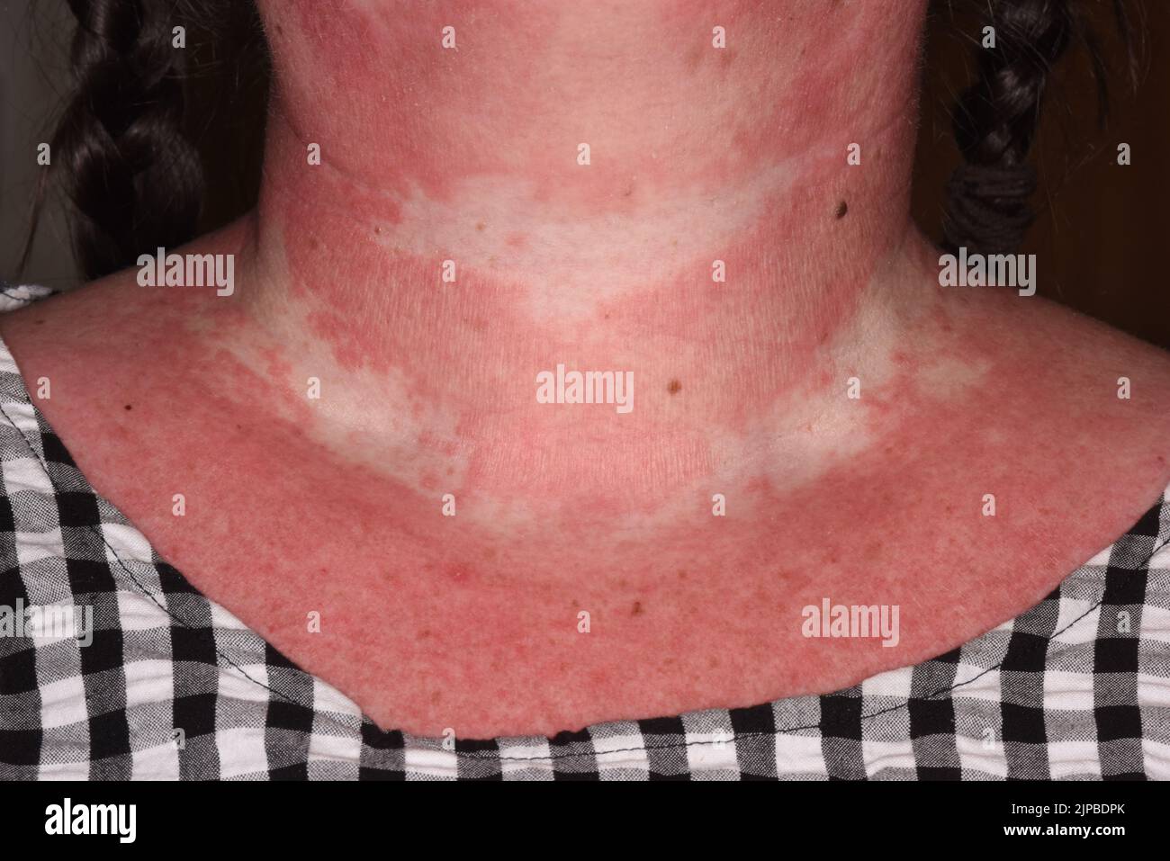Systemic lupus erythematosus rash after covid vaccine stock photo alamy