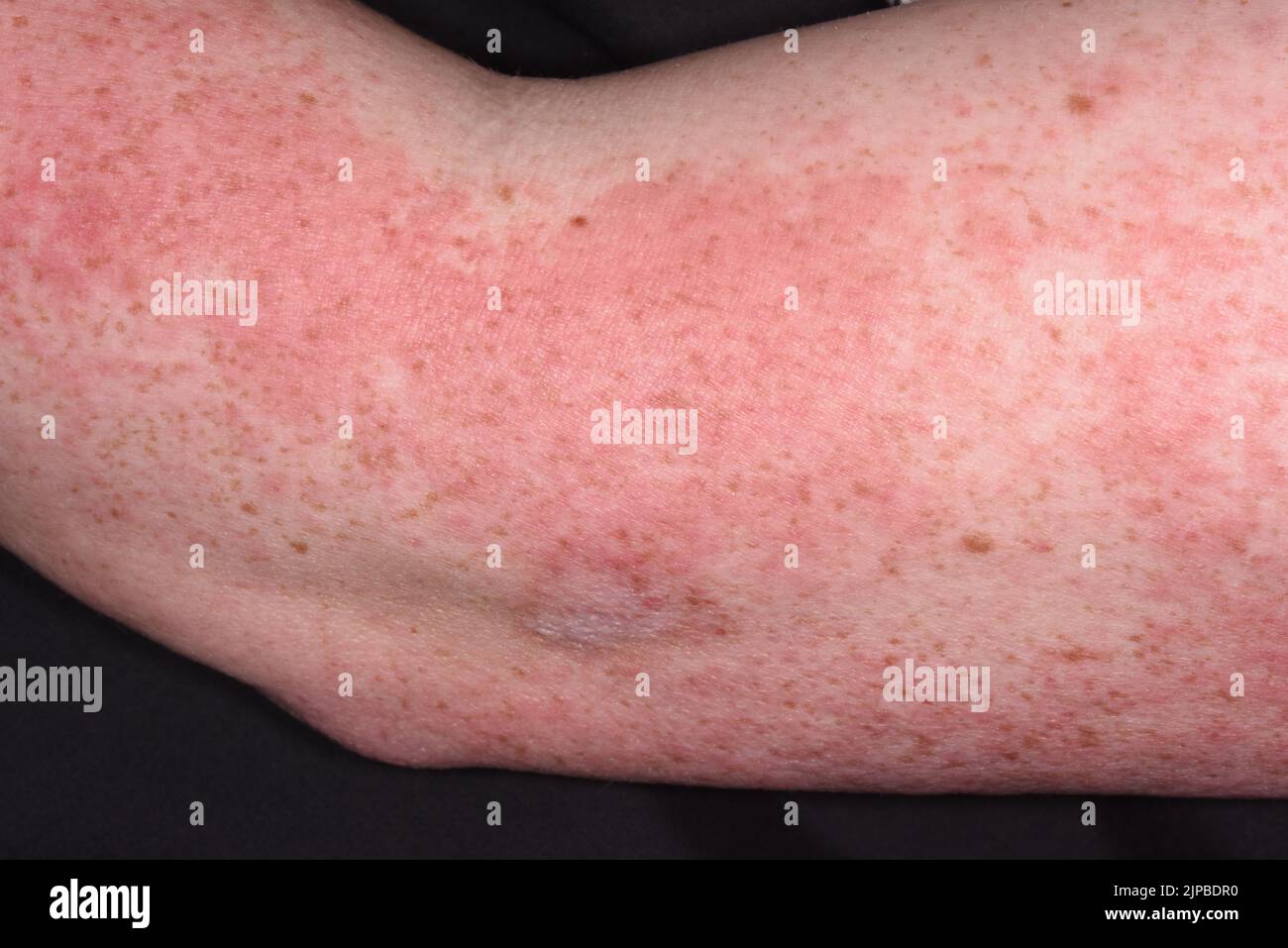 Systemic lupus erythematosus rash after covid vaccine stock photo alamy