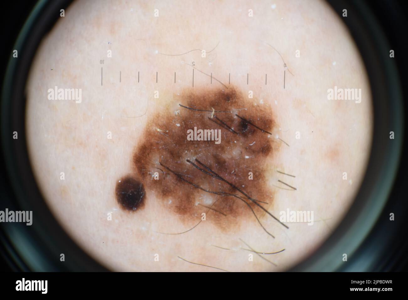 Congenital naevus, dermoscopy image Stock Photo - Alamy