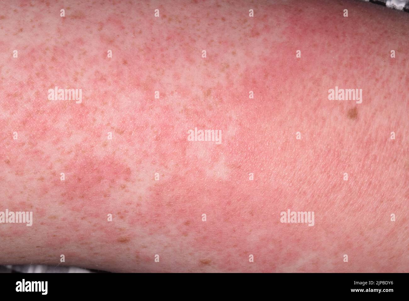 Systemic lupus erythematosus rash after Covid vaccine Stock Photo - Alamy