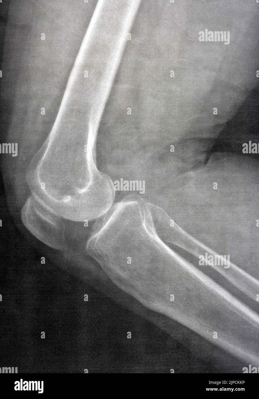 Plain X ray of the right knee shows apparent joint osteoarthritis according to Kellgren and Lawrence system for classification of osteoarthritis with Stock Photo