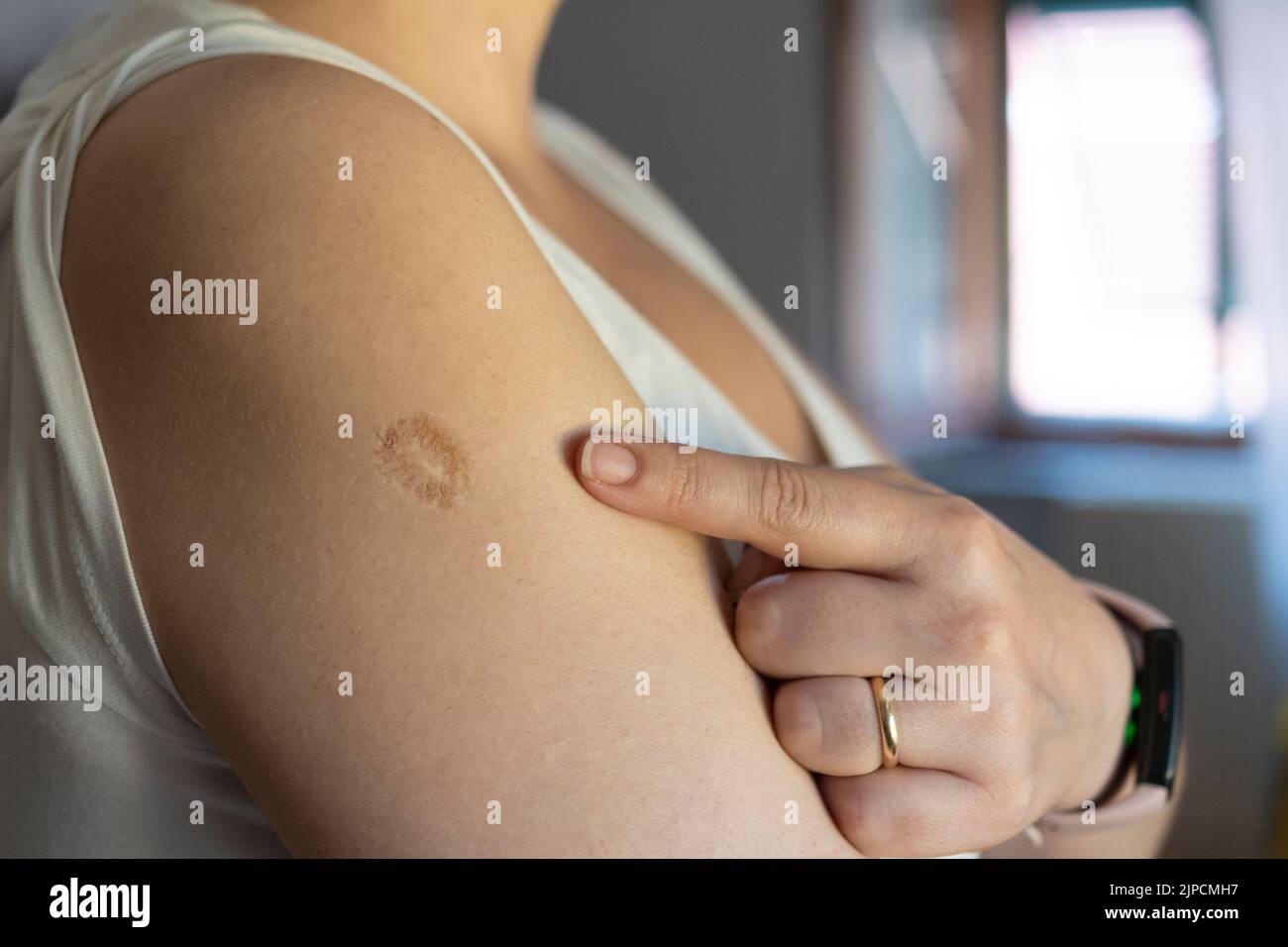 Monkeypox and smallpox vaccine concept: woman shows smallpox vaccine scar on her arm Stock Photo