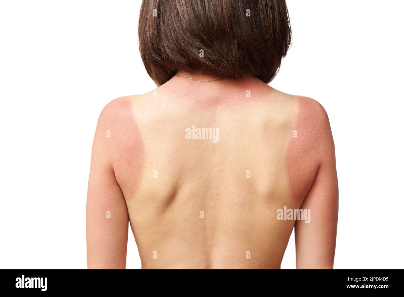 Red skin after sunburn on female shoulders, skin care and protection concept Stock Photo
