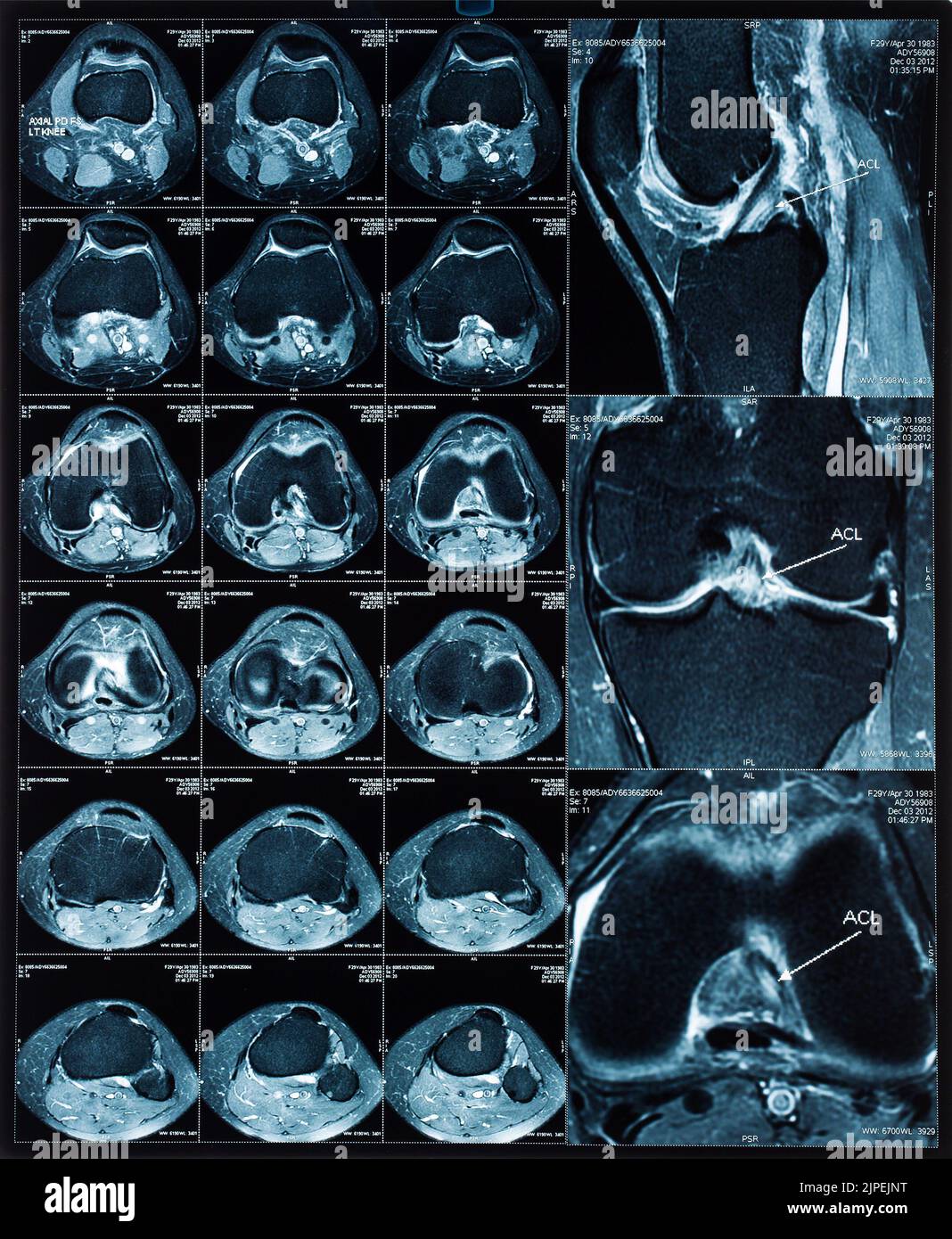 knee, mri, magnetic resonance imaging, knees, mris, mri scan Stock Photo