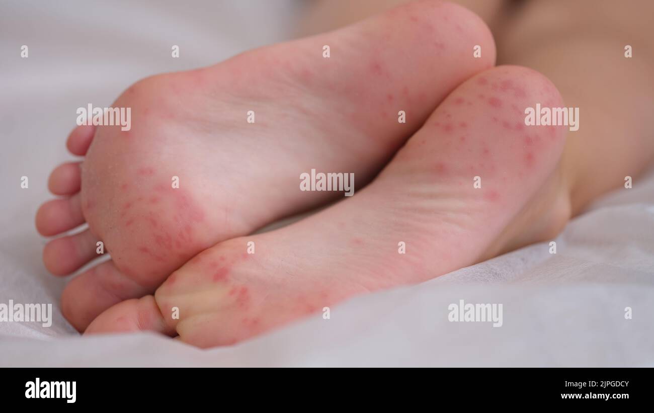Children foot with dermatitis allergic rash closeup Stock Photo Alamy