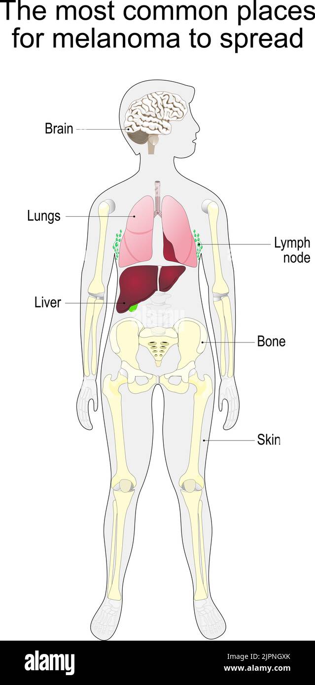 metastasis of skin cancer. malignant melanoma. The most common places for melanoma to spread. vector diagram Stock Vector