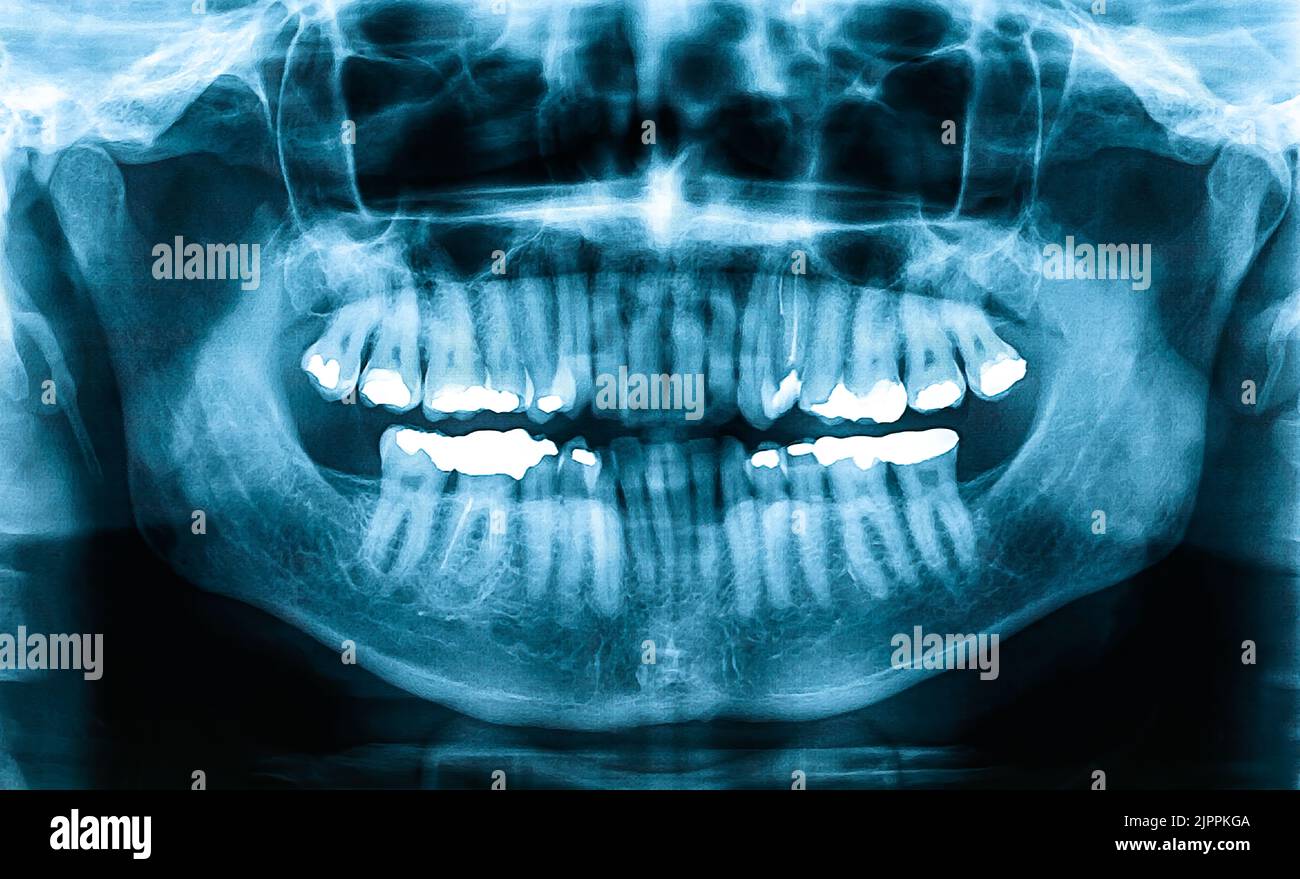 Panoramic Dental XRay, Orthopantomogram single panoramic image of the