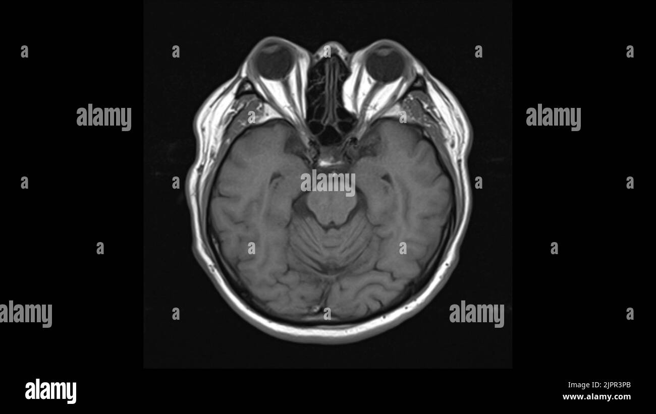 Healthy Brain Mri Scan Stock Photo Alamy Healthy Brain Mri Scan Stock Photo Alamy