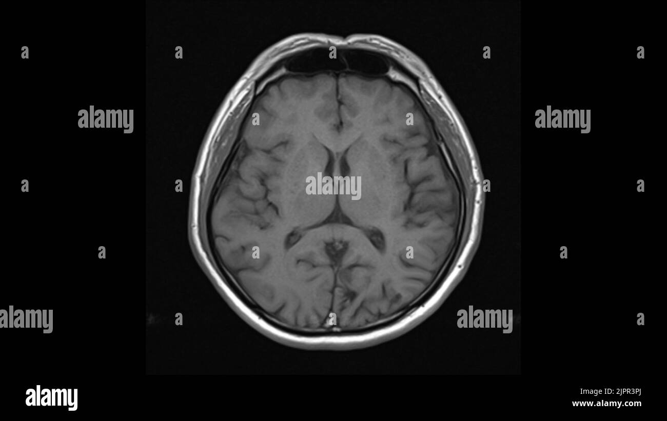 Healthy brain, MRI scan Stock Photo