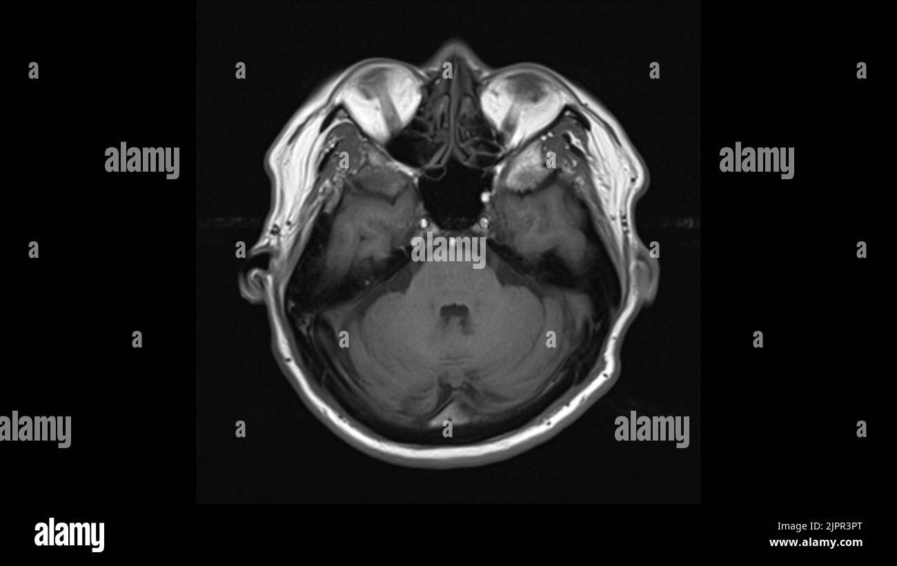 Healthy brain, MRI scan Stock Photo