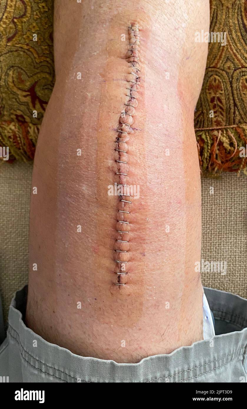 Human knee with staples after a knee replacement surgery on a pillow for elevation. Stock Photo