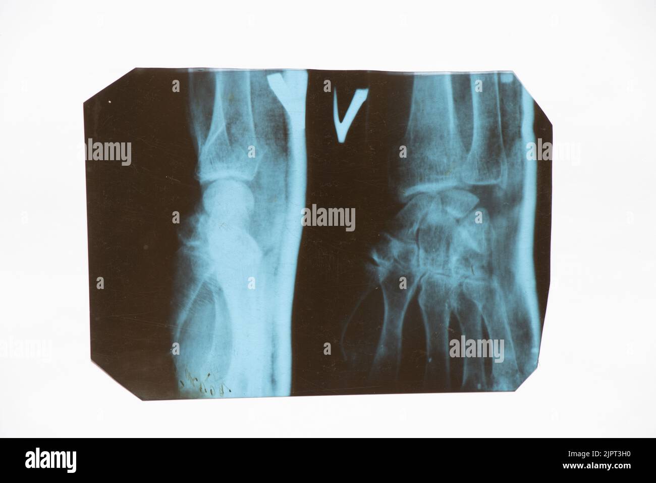 xrays of a woman's hand with a fracture, xray, health care and