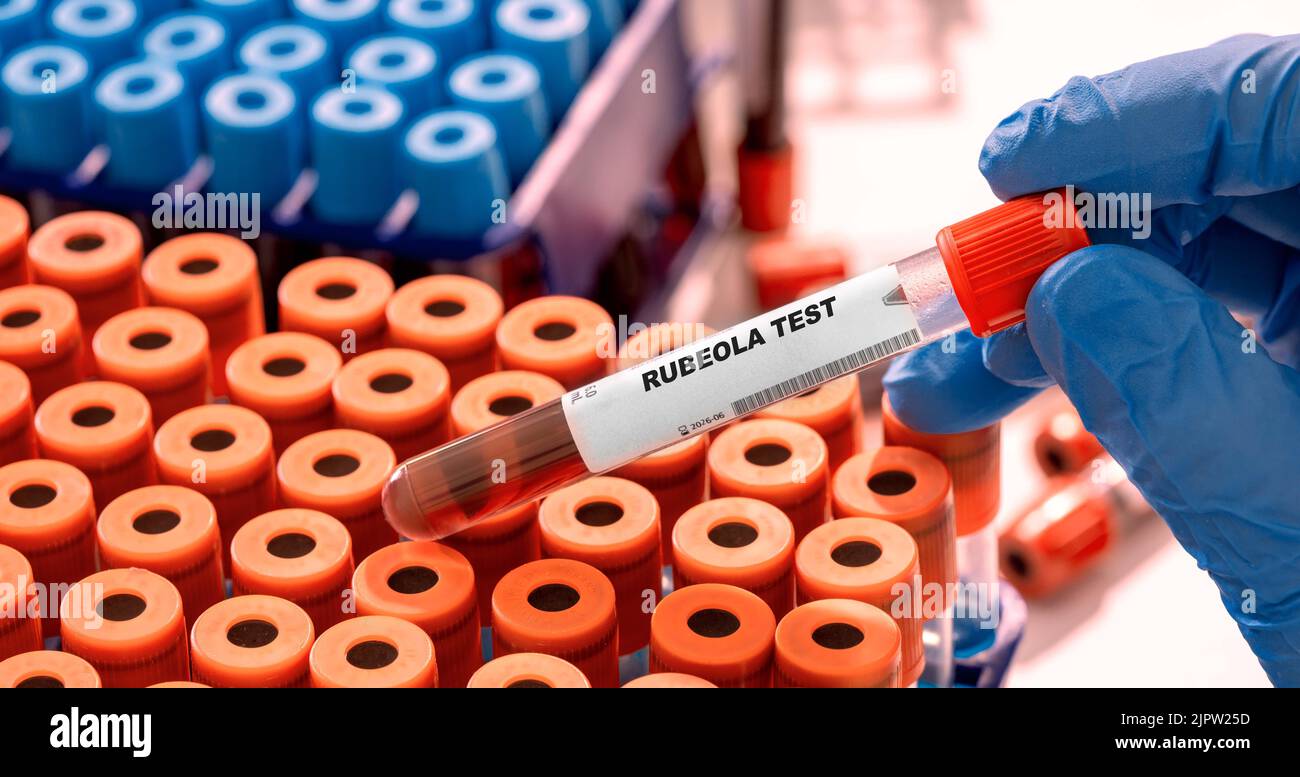 Rubeola Test tube with blood sample in infection lab Stock Photo