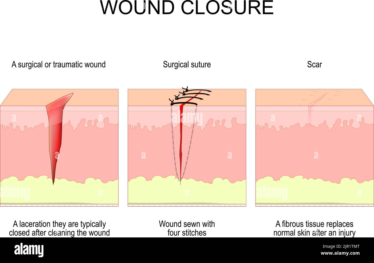 Wound closure. From surgical or traumatic wound to suture and scar. A laceration they are typically closed after cleaning the wound. Wound sewn with f Stock Vector