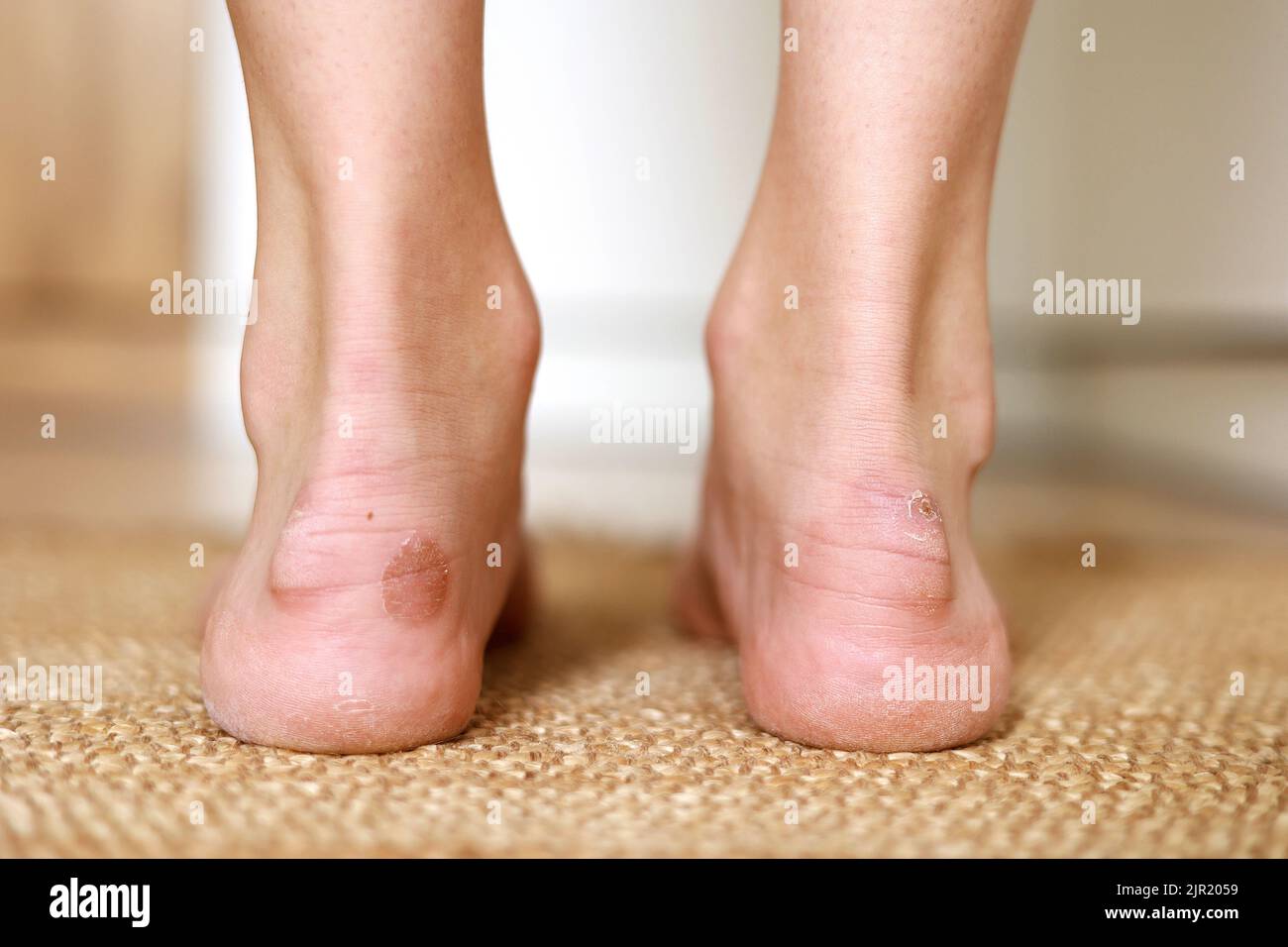 Callus blisters on woman feet. Painful wounds. shoes problems. View of foot with