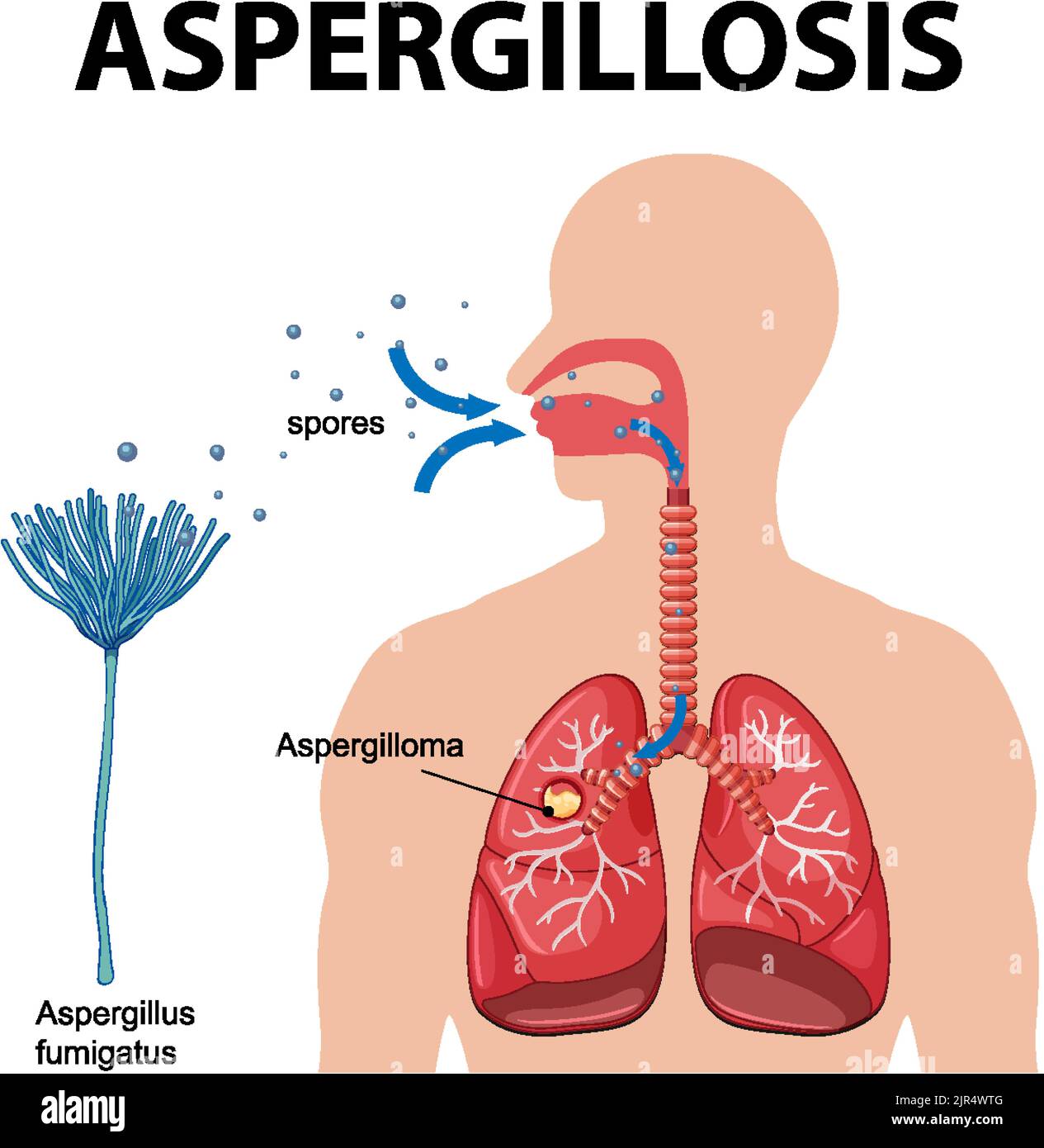 Diagram showing aspergillus infection illustration Stock Vector Image ...