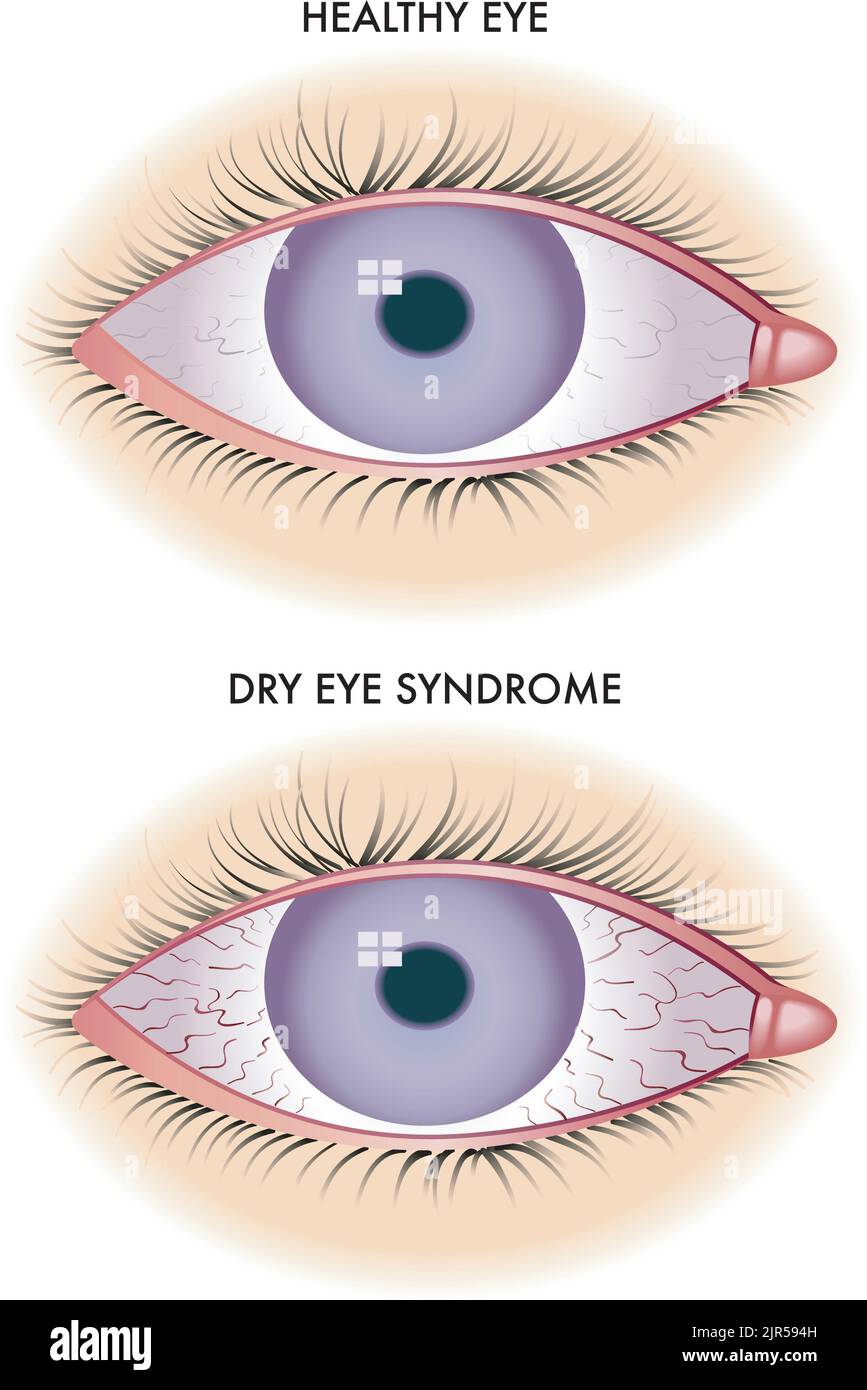 Symbolic medical illustration shows one healthy eye and one affected by dry eye syndrome. Stock Vector