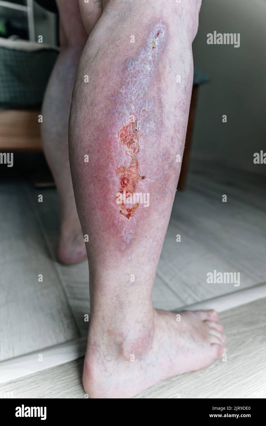Large healing wound on the lower leg with scars, redness, scarring of the skin, the concept of human tissue regeneration.  Stock Photo